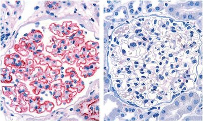Immunohistochemistry (IgG1 dye) of renal tissue samples  Left: Inflamed renal corpuscules of a patient with pMN; antibodies in the area of the glomerular basement membrane (red) Right: Healthy kidney tissue; no antibodies detected (modified illustration from: Hoxha et al., Kidney Int. 82, 797-804 (2012))