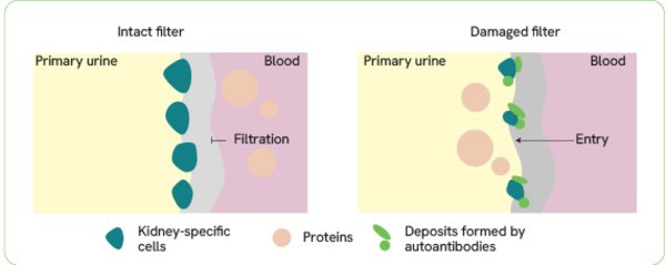 Impaired kidney filter function due to antibody-mediated deposits 