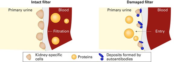 Disturbed filter function of the kidney due to antibody-caused deposits