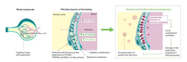 PLA2R, THSD7A and NELL1 are expressed on the surface of the podocytes.