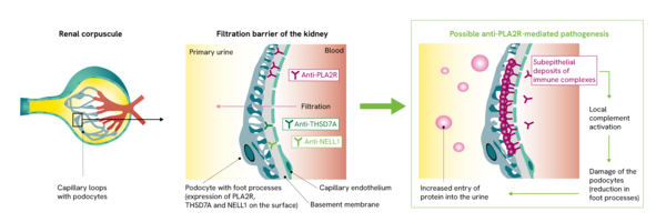 PLA2R, THSD7A and NELL1 are expressed on the surface of the podocytes.